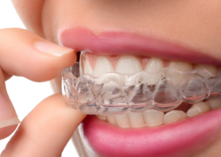 Schienenbehandlung Invisalign Erlangen Schienenbehandlung Invisalign Erlangen