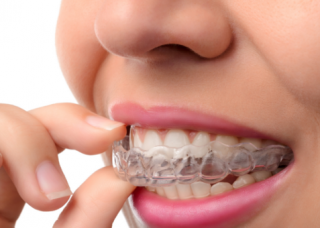 Schienenbehandlung Invisalign Erlangen Schienenbehandlung Invisalign Erlangen