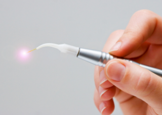 Zahnlaser: Laserbehandlung Erlangen Zahnlaser: Laserbehandlung Erlangen